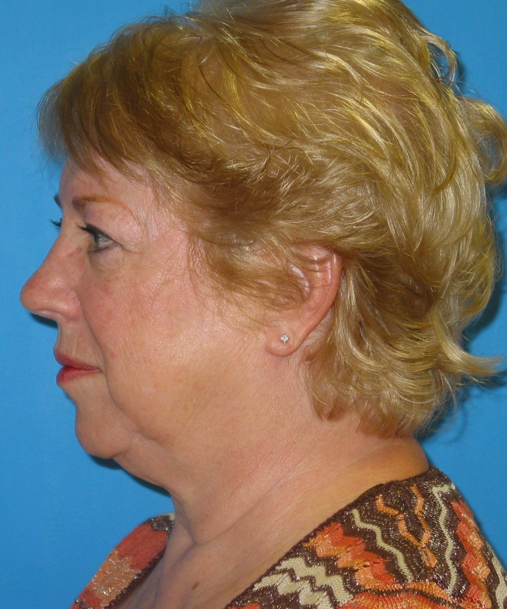 Prendiville Signature Lift before