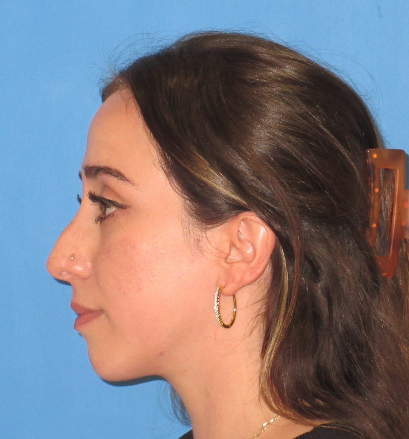 Rhinoplasty before