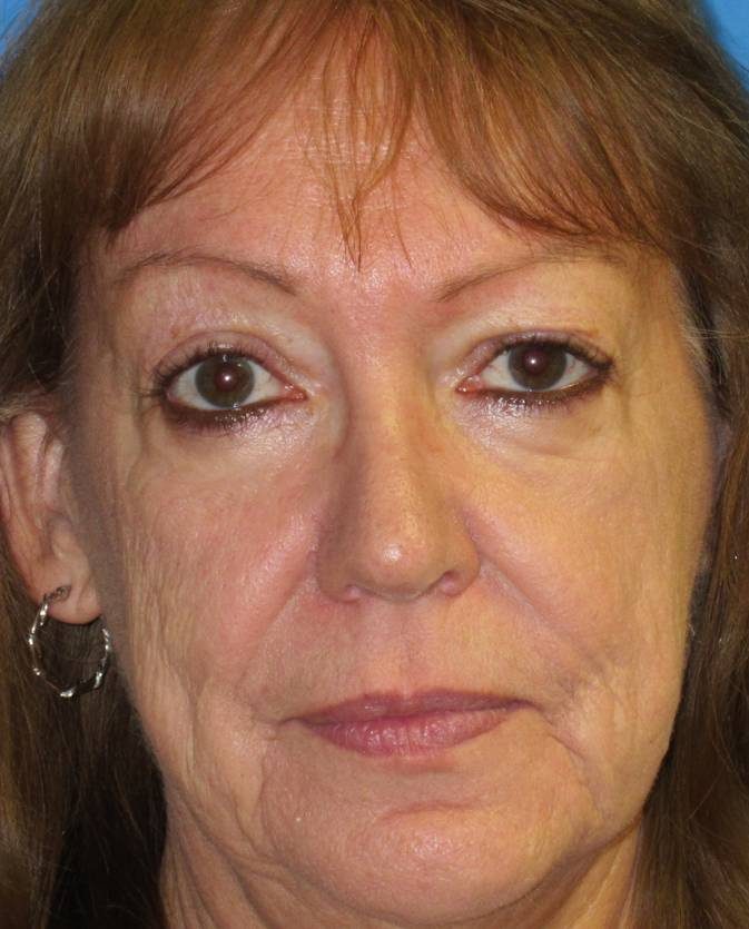 Rhinoplasty after