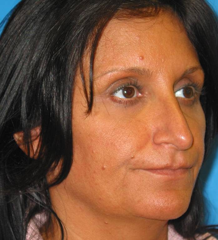 Rhinoplasty before