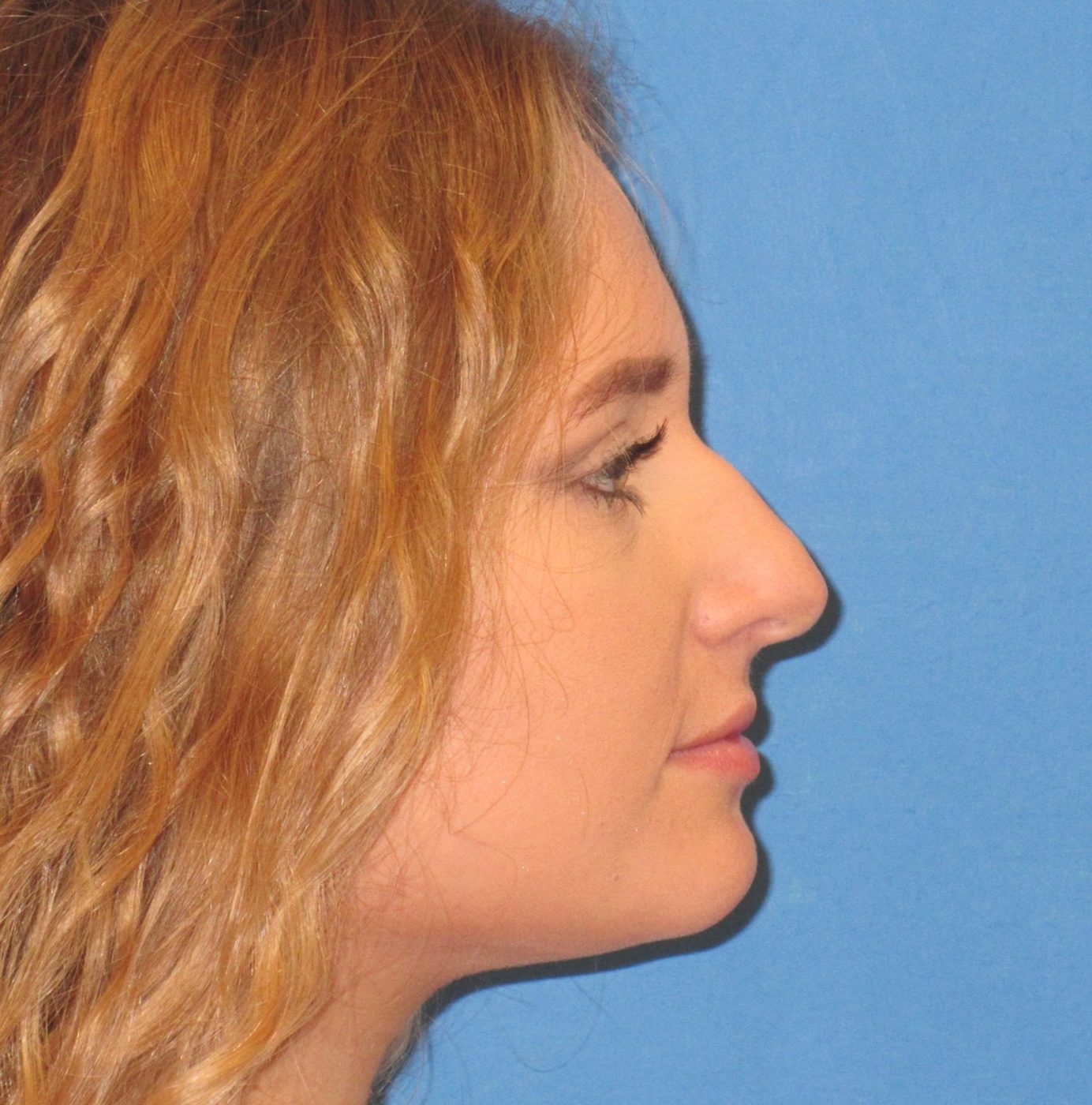 Rhinoplasty before