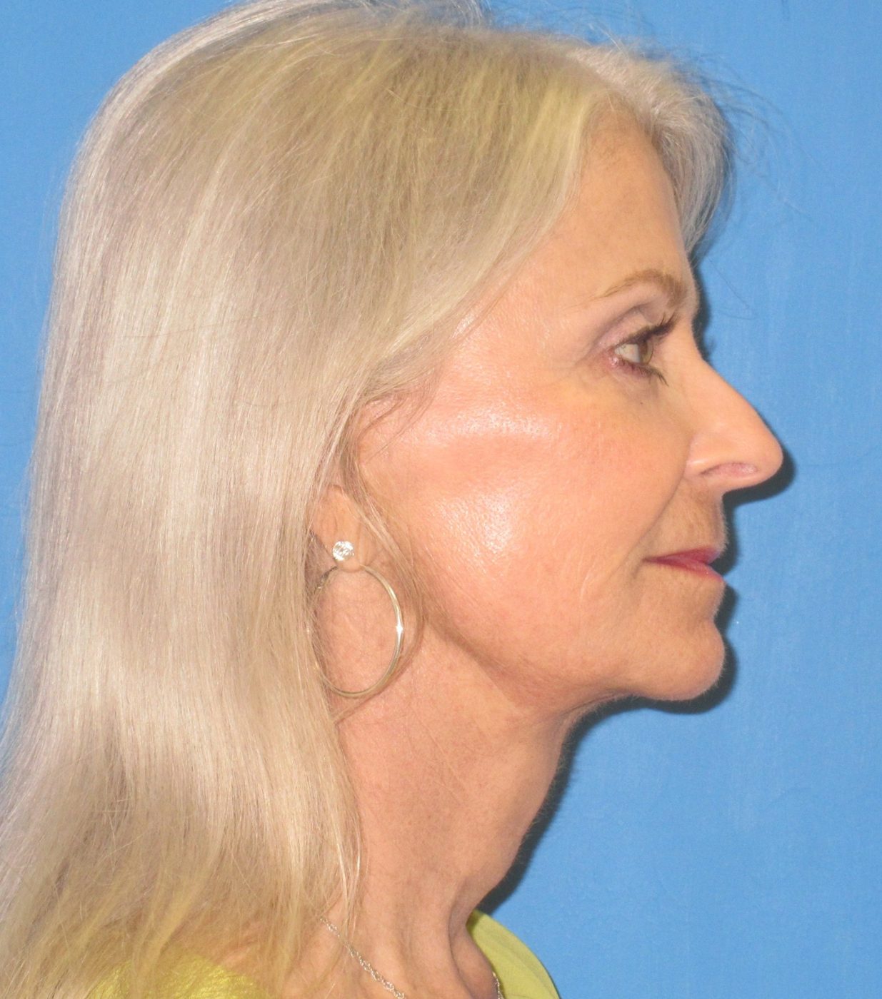 Prendiville Signature Lift after
