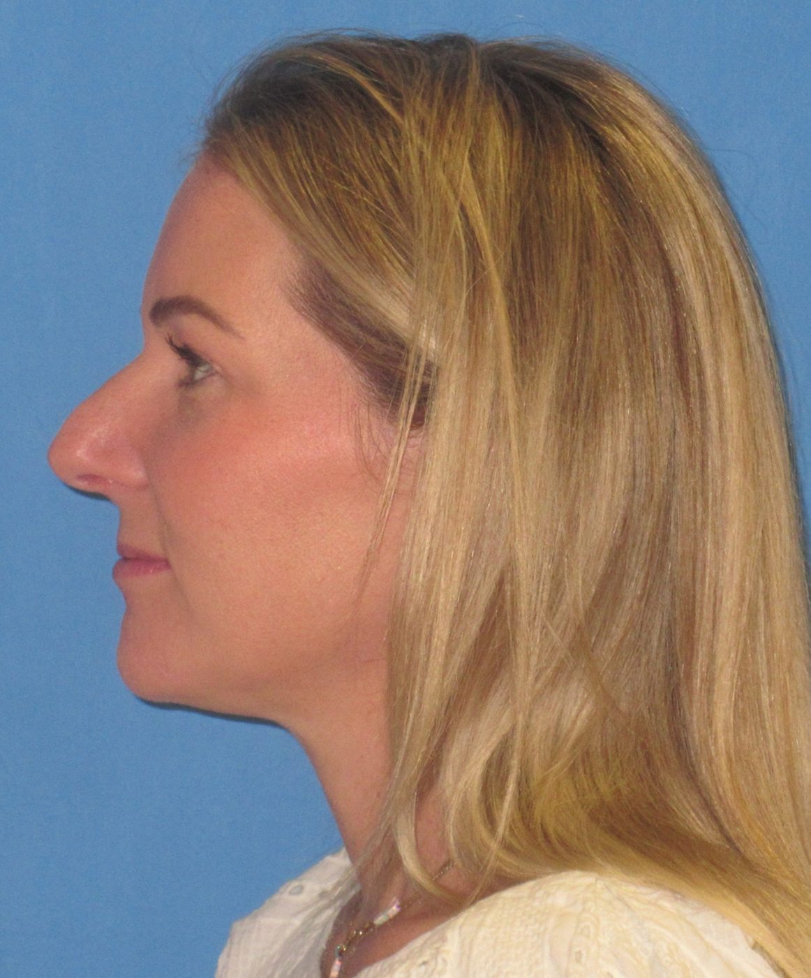 Rhinoplasty before