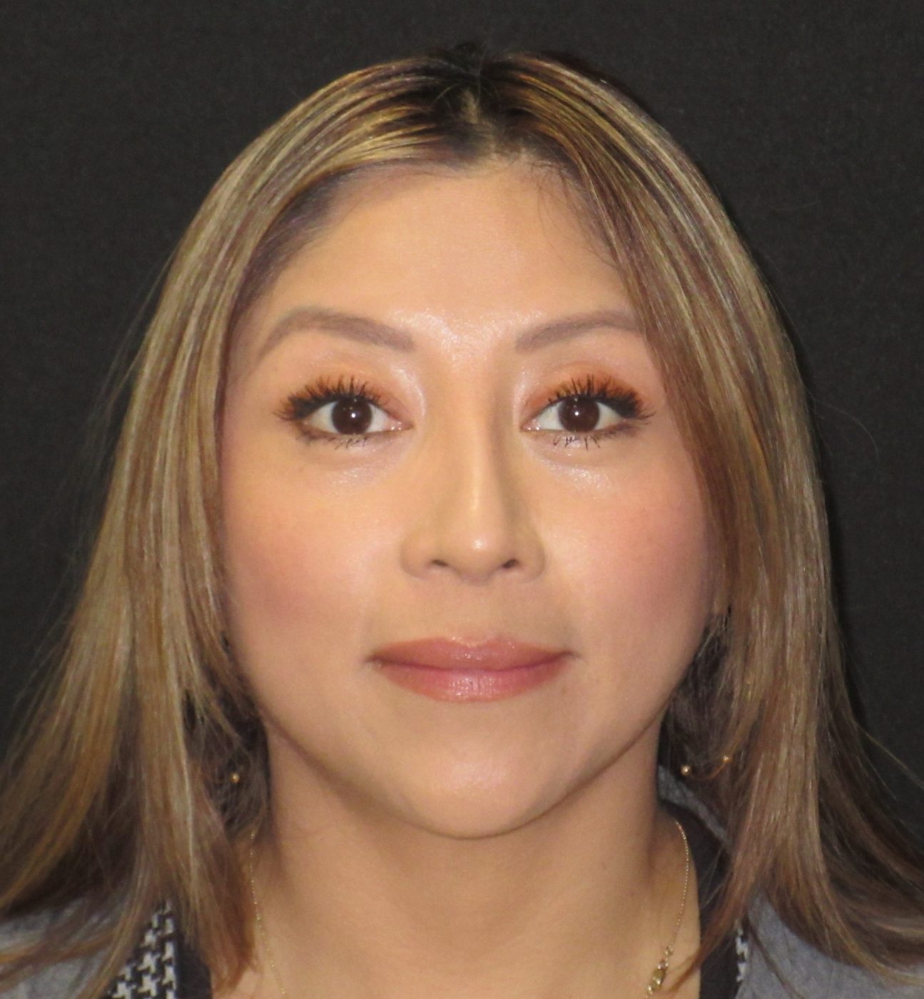 Eyelid Lift after