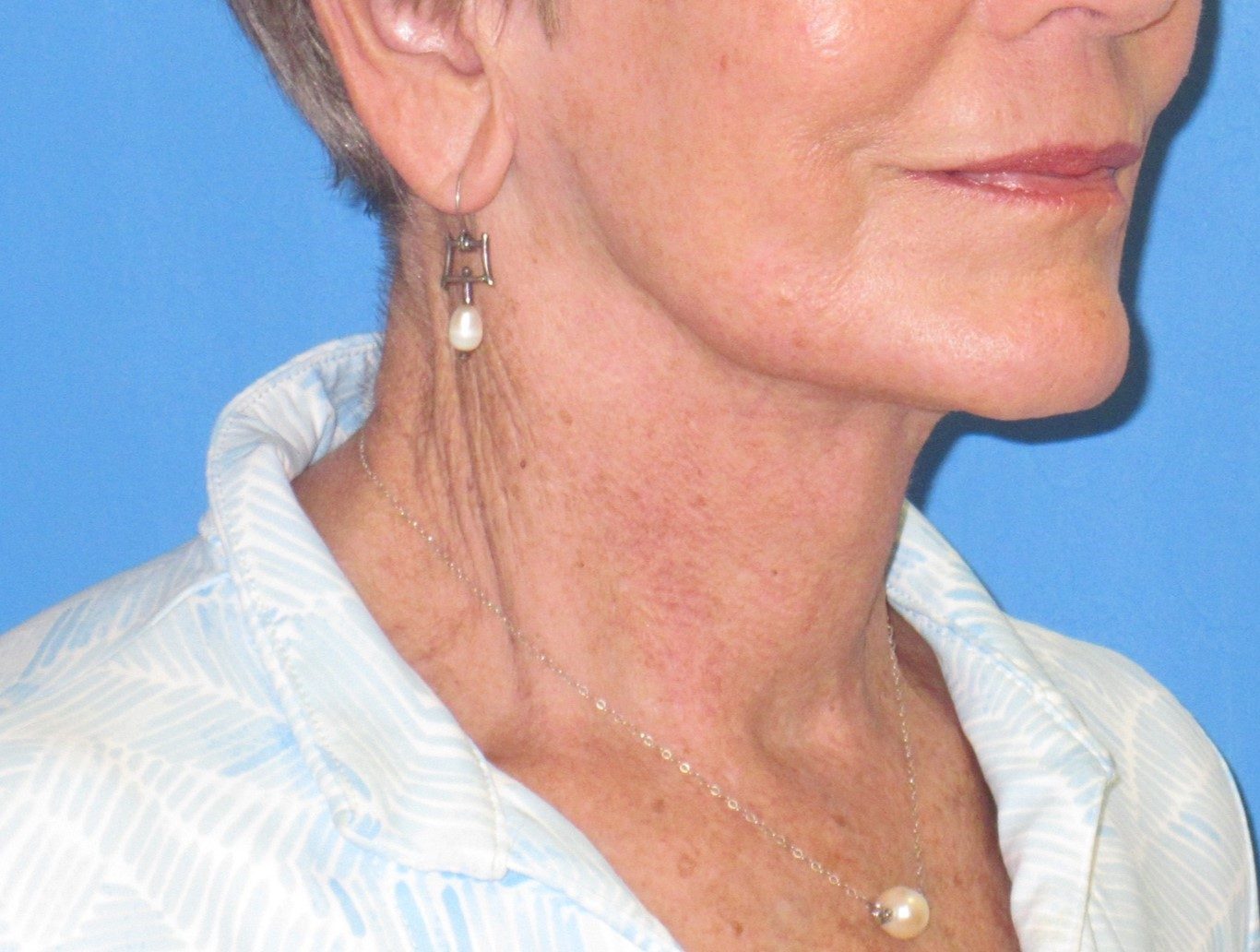 Deep Neck Contouring after