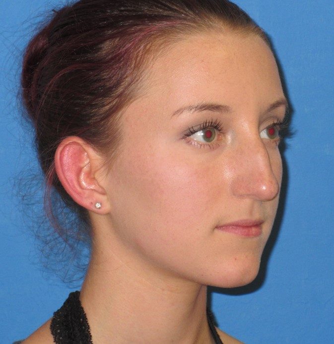 Rhinoplasty before