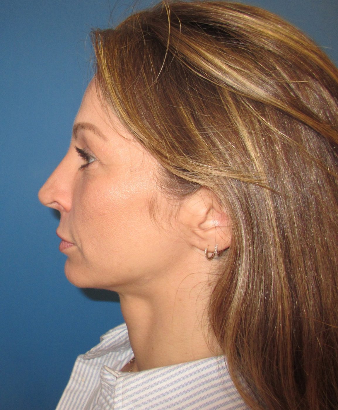 Rhinoplasty after