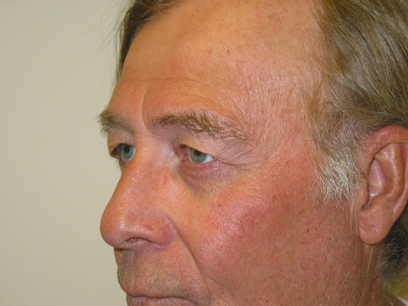Eyelid Lift before