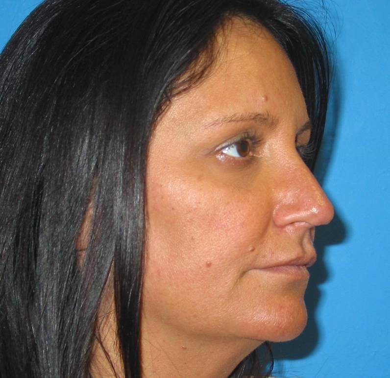 Rhinoplasty after