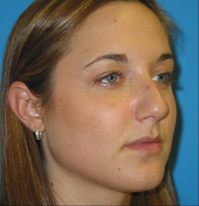 Rhinoplasty before