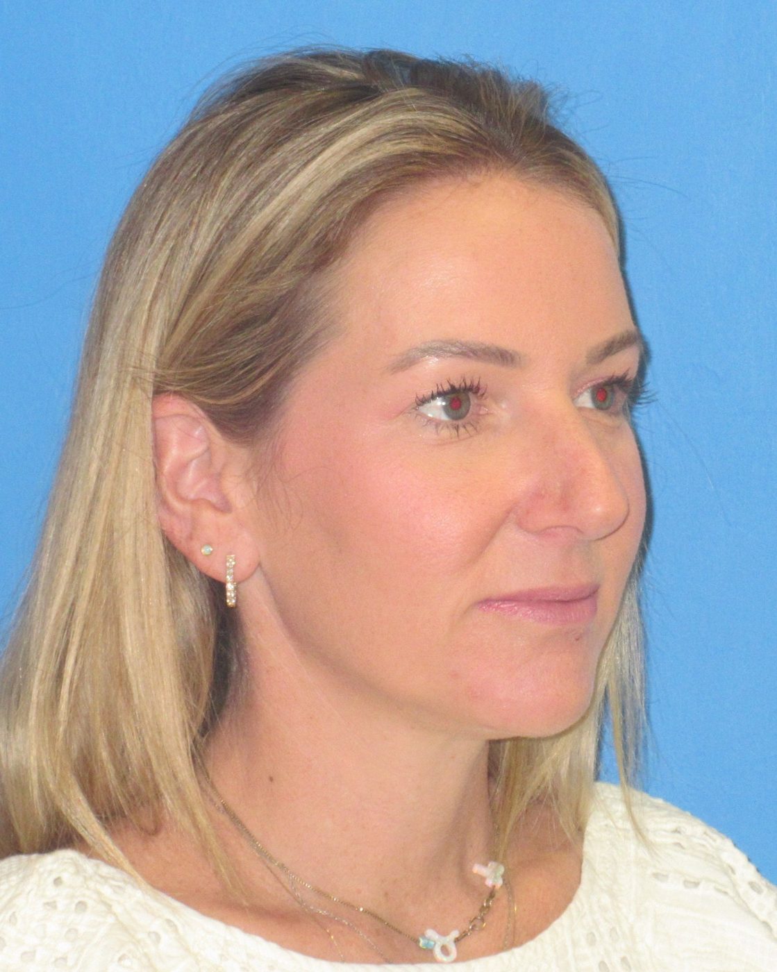 Rhinoplasty before