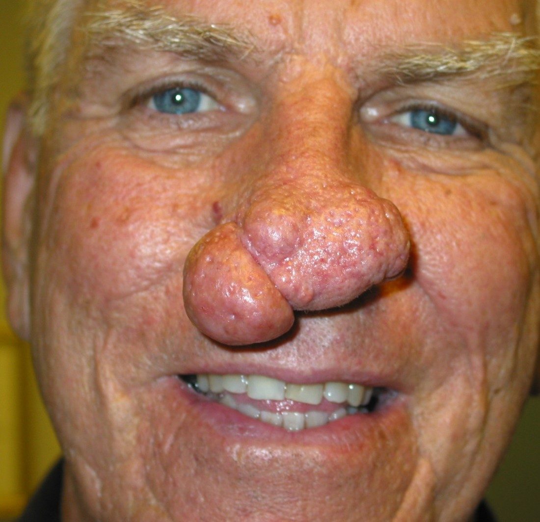 Reconstructive & Laser Therapy before