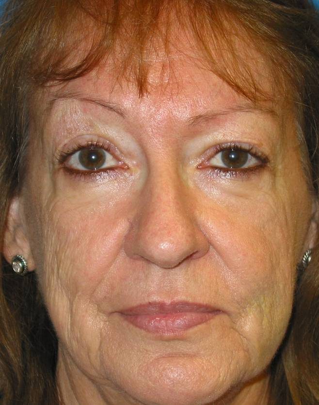 Rhinoplasty before