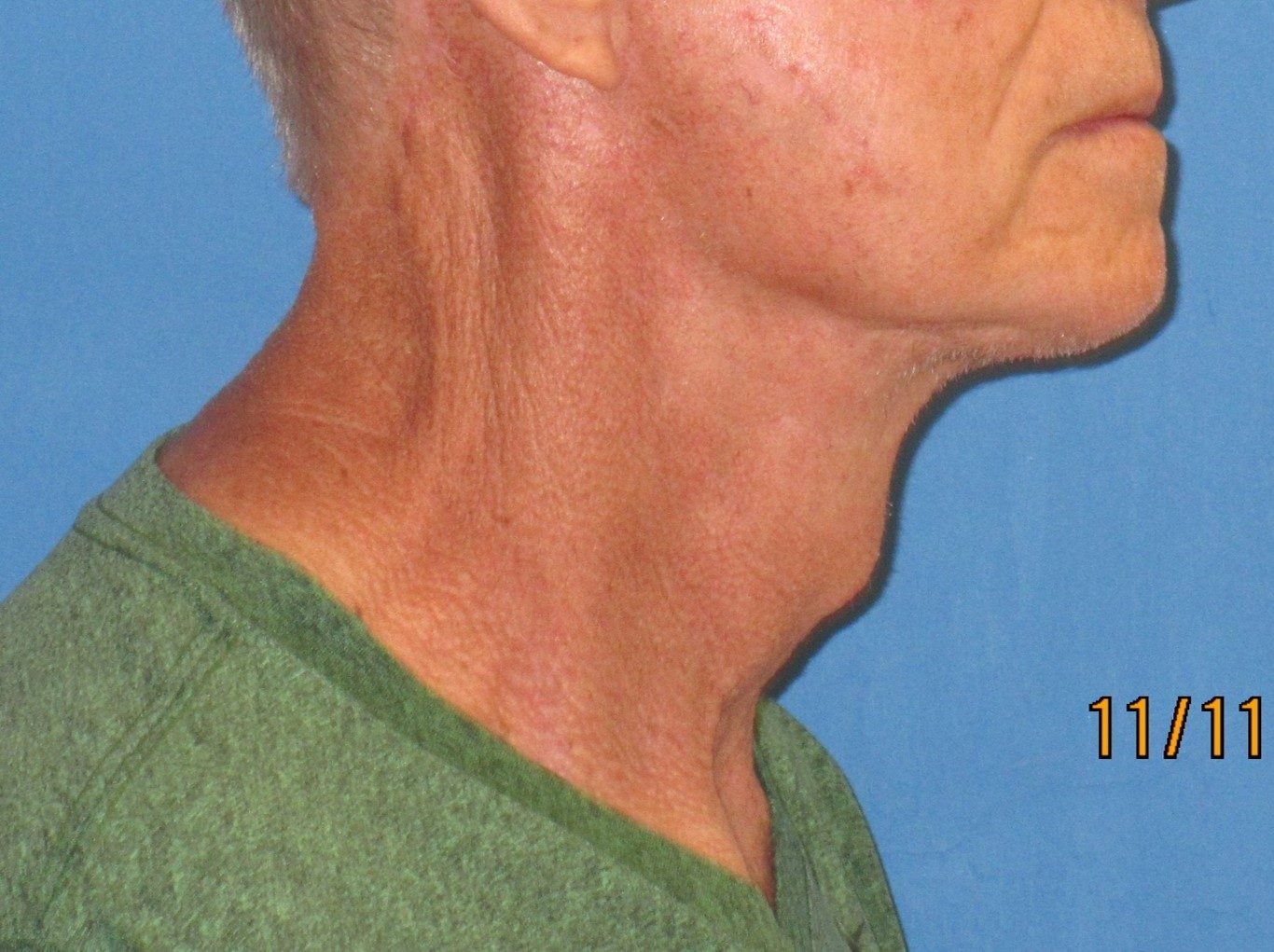 Deep Neck Contouring before