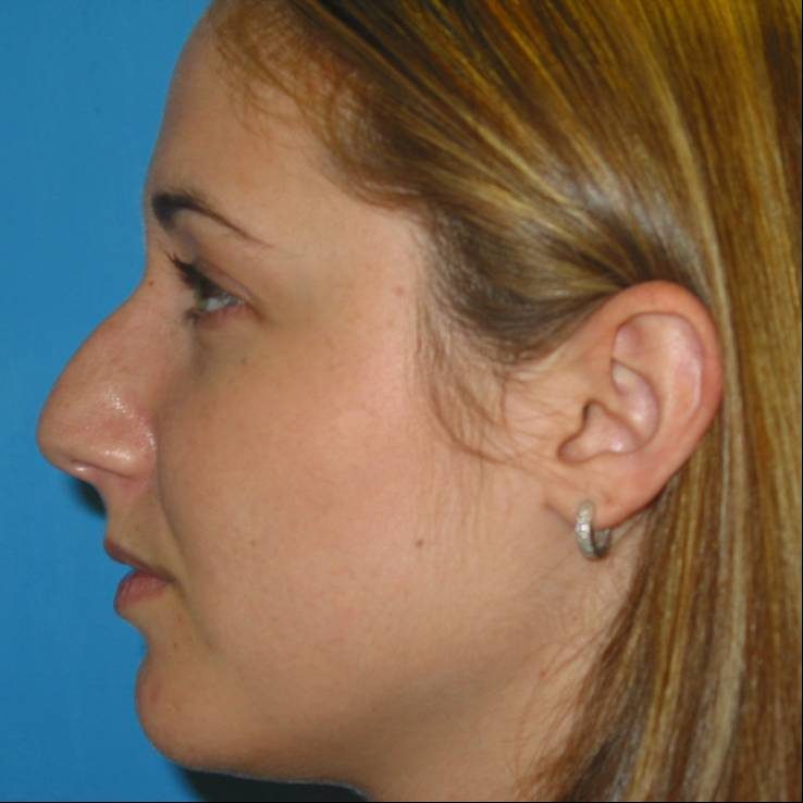 Rhinoplasty before
