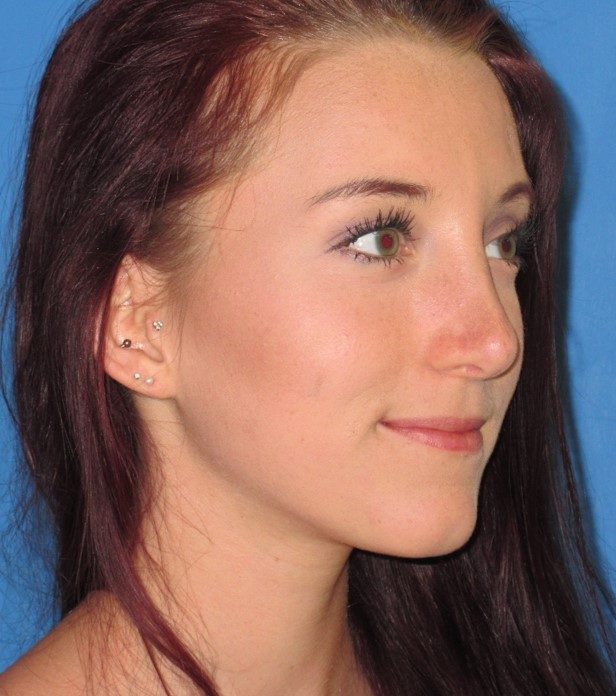 Rhinoplasty after