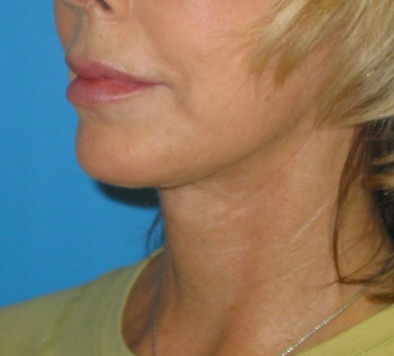 Deep Neck Contouring after