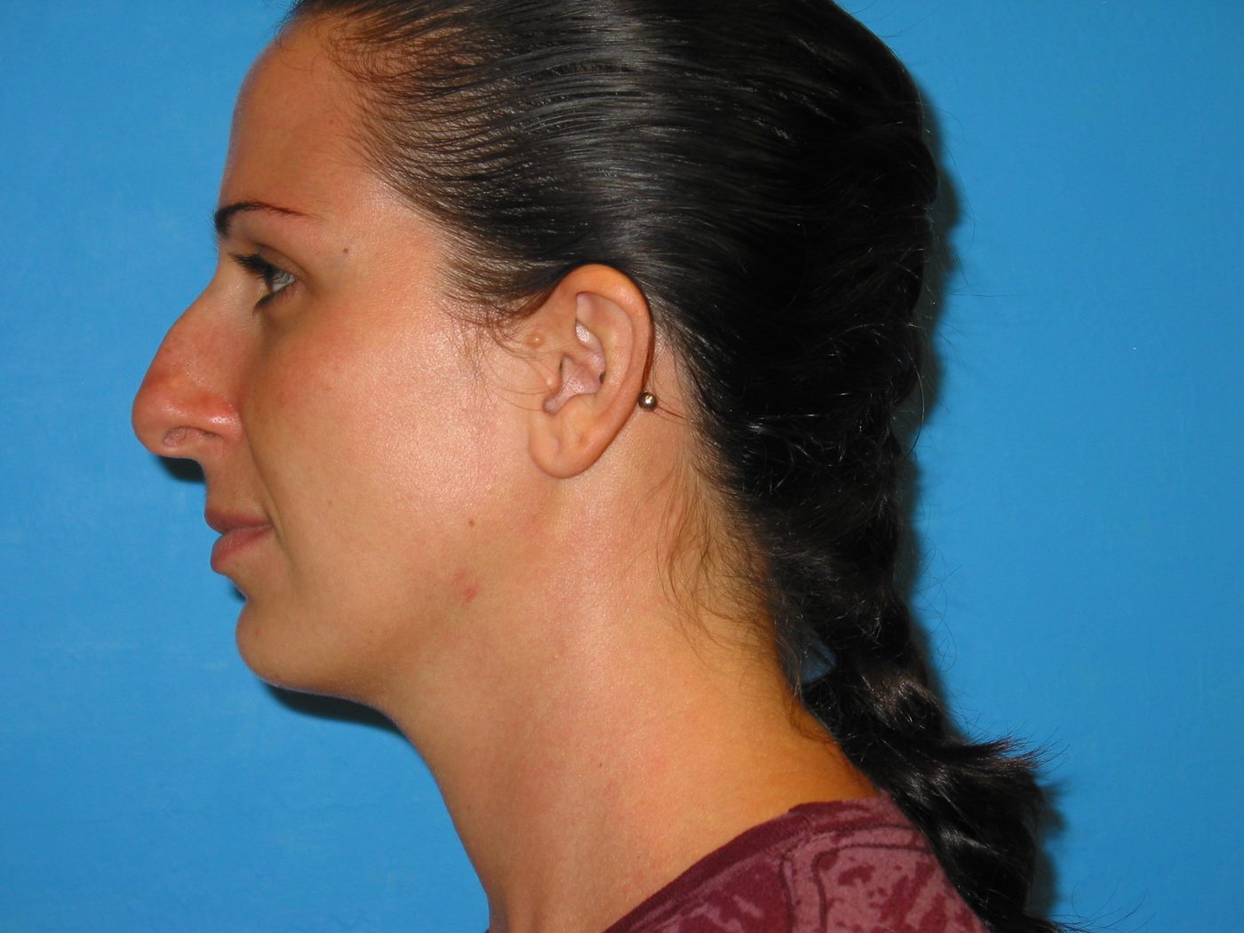 Rhinoplasty before
