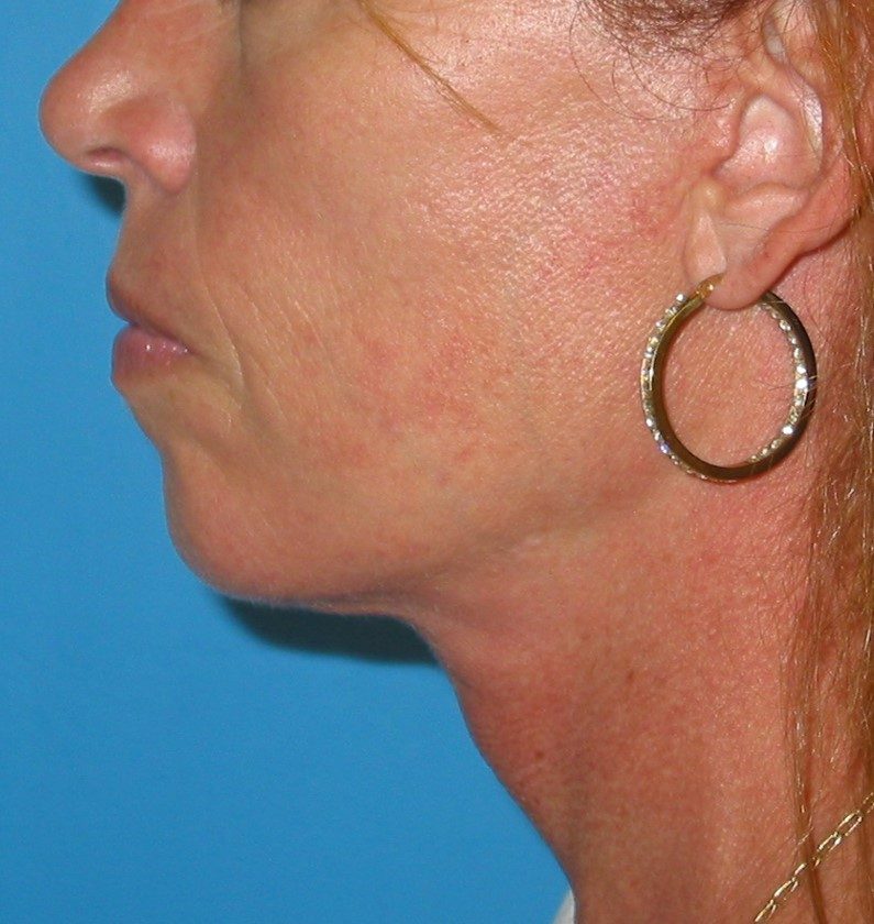 Deep Neck Contouring after