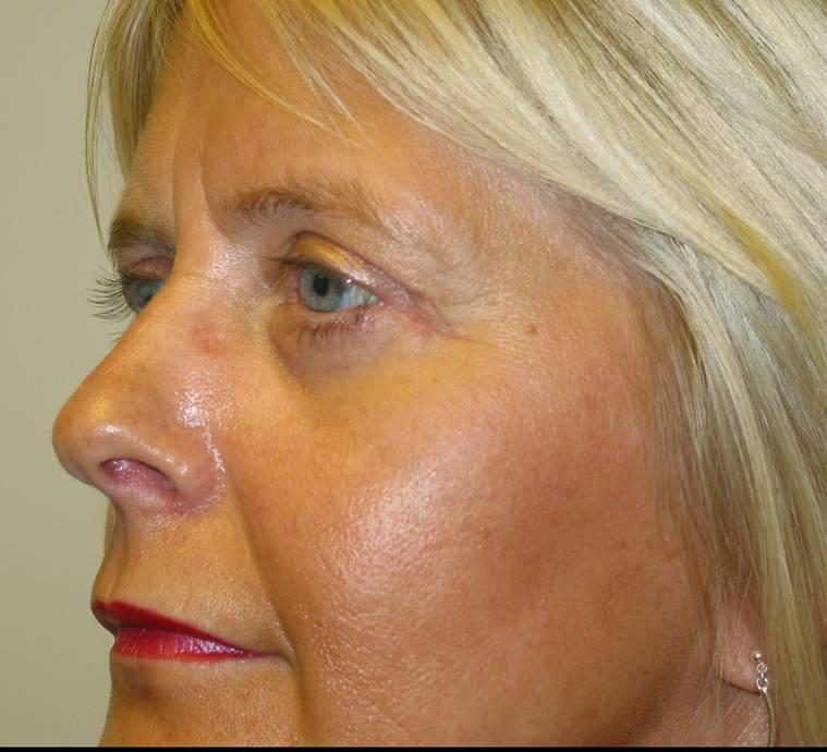 Eyelid Lift after