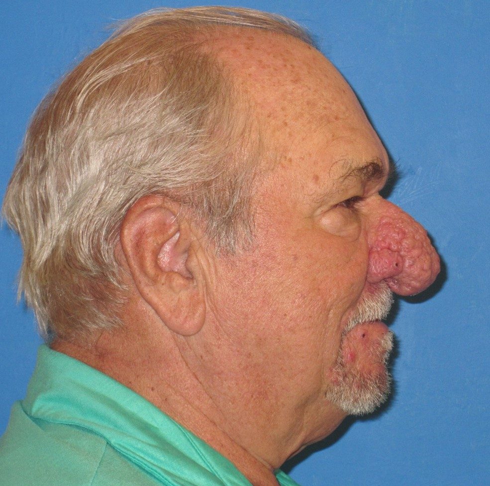 Reconstructive & Laser Therapy before
