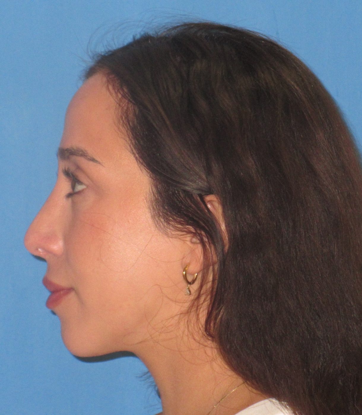 Rhinoplasty after
