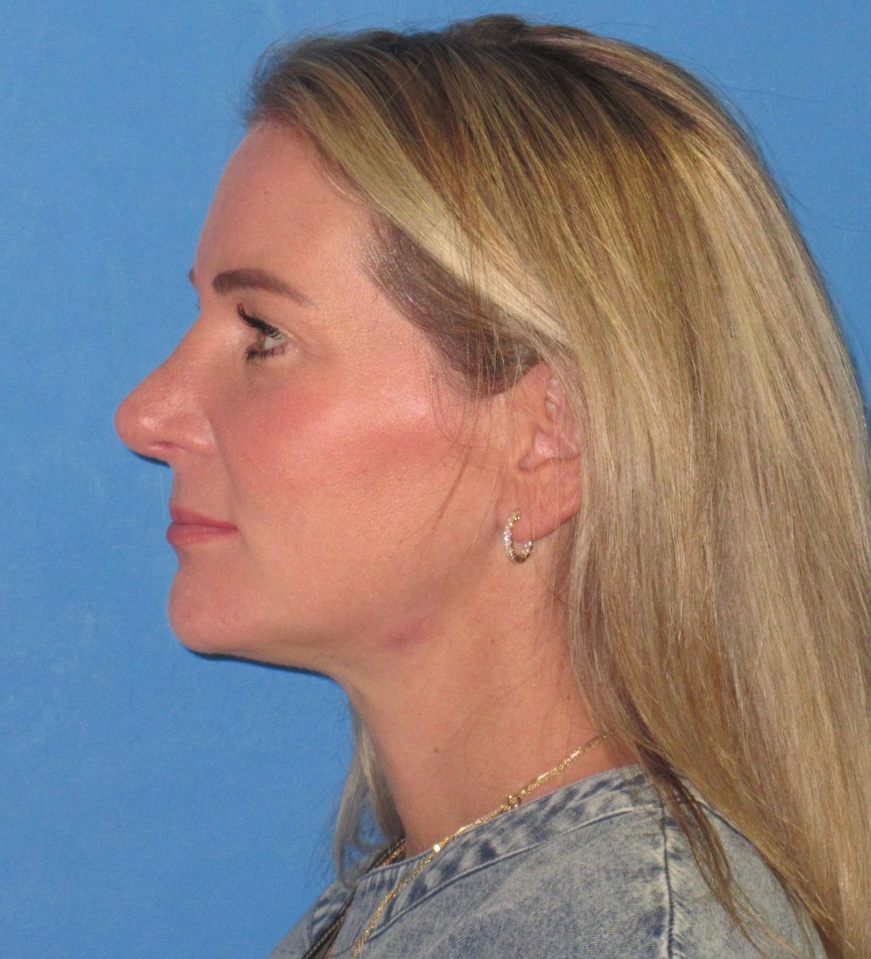 Rhinoplasty after