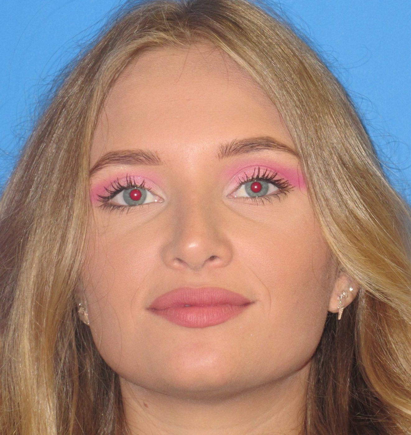 Rhinoplasty after