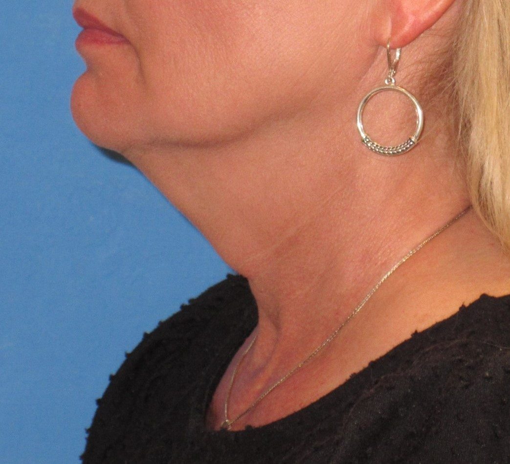 Deep Neck Contouring before