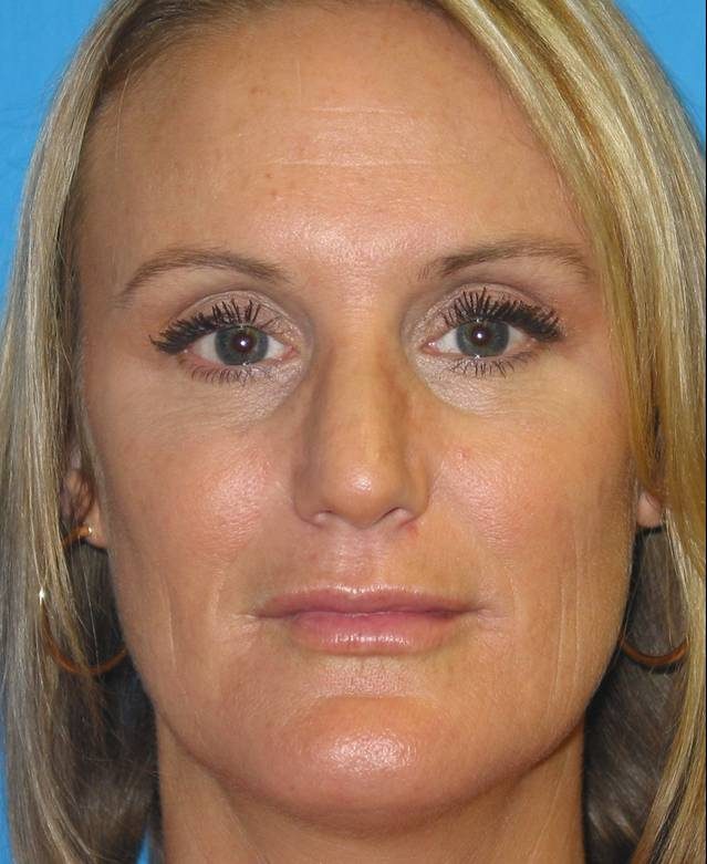 Rhinoplasty after