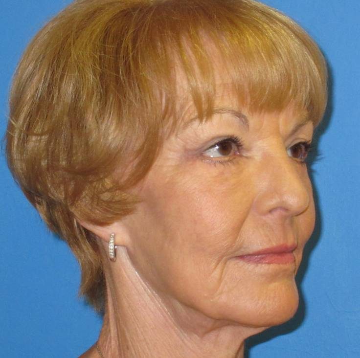 Endoscopic Brow Lift after