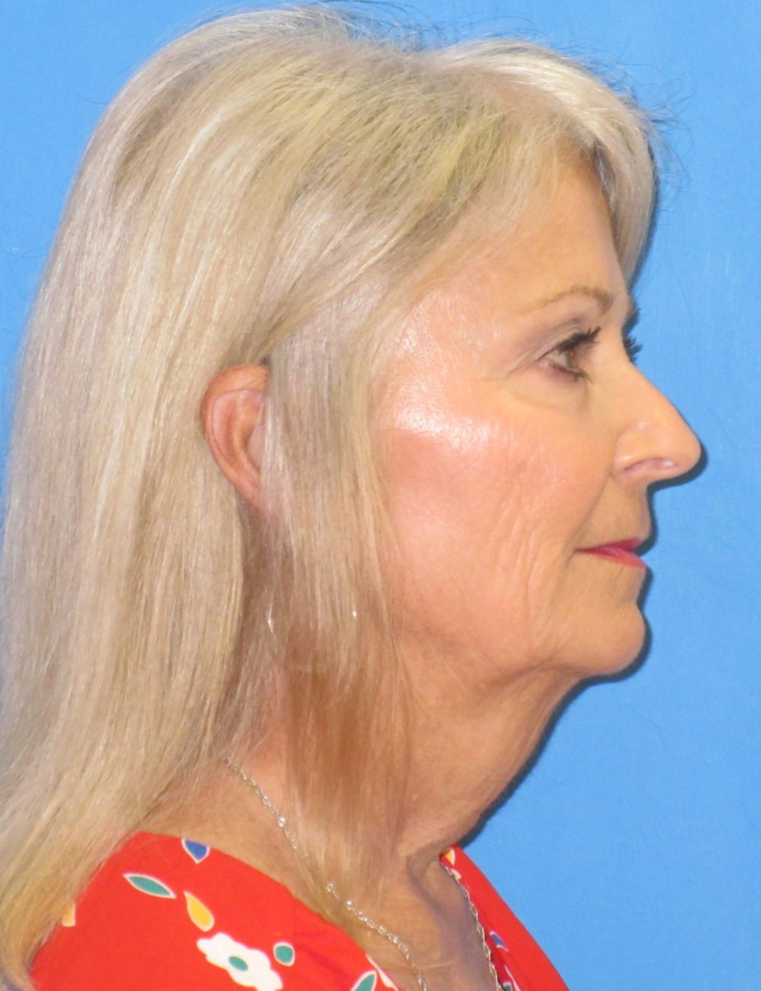 Prendiville Signature Lift before