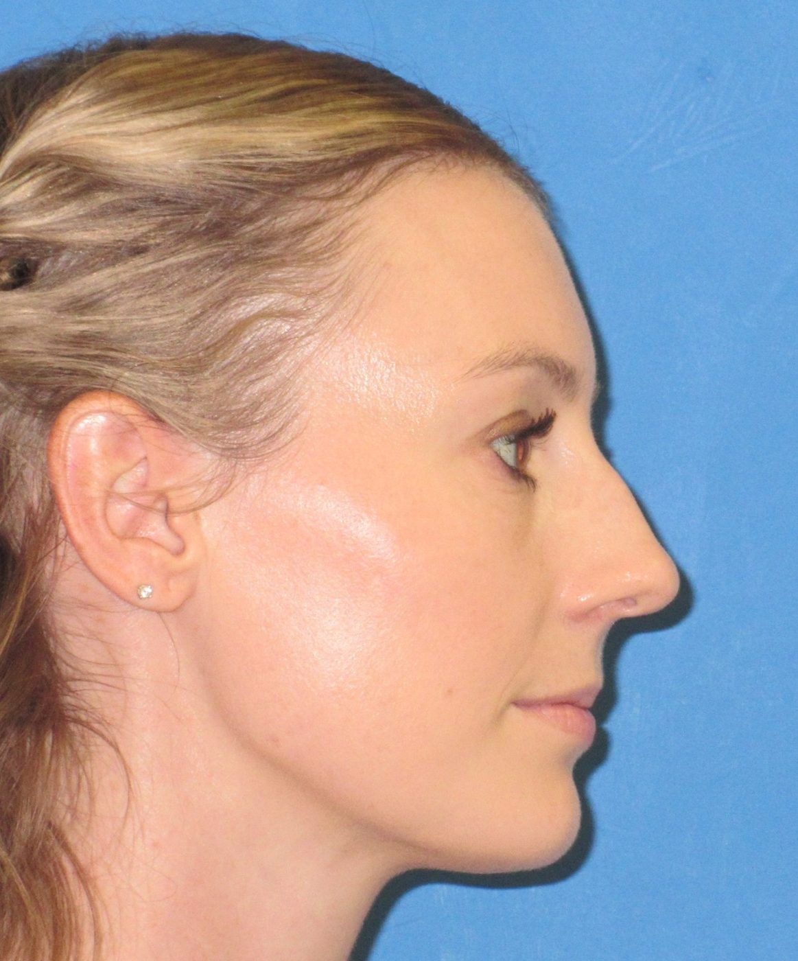 Rhinoplasty before