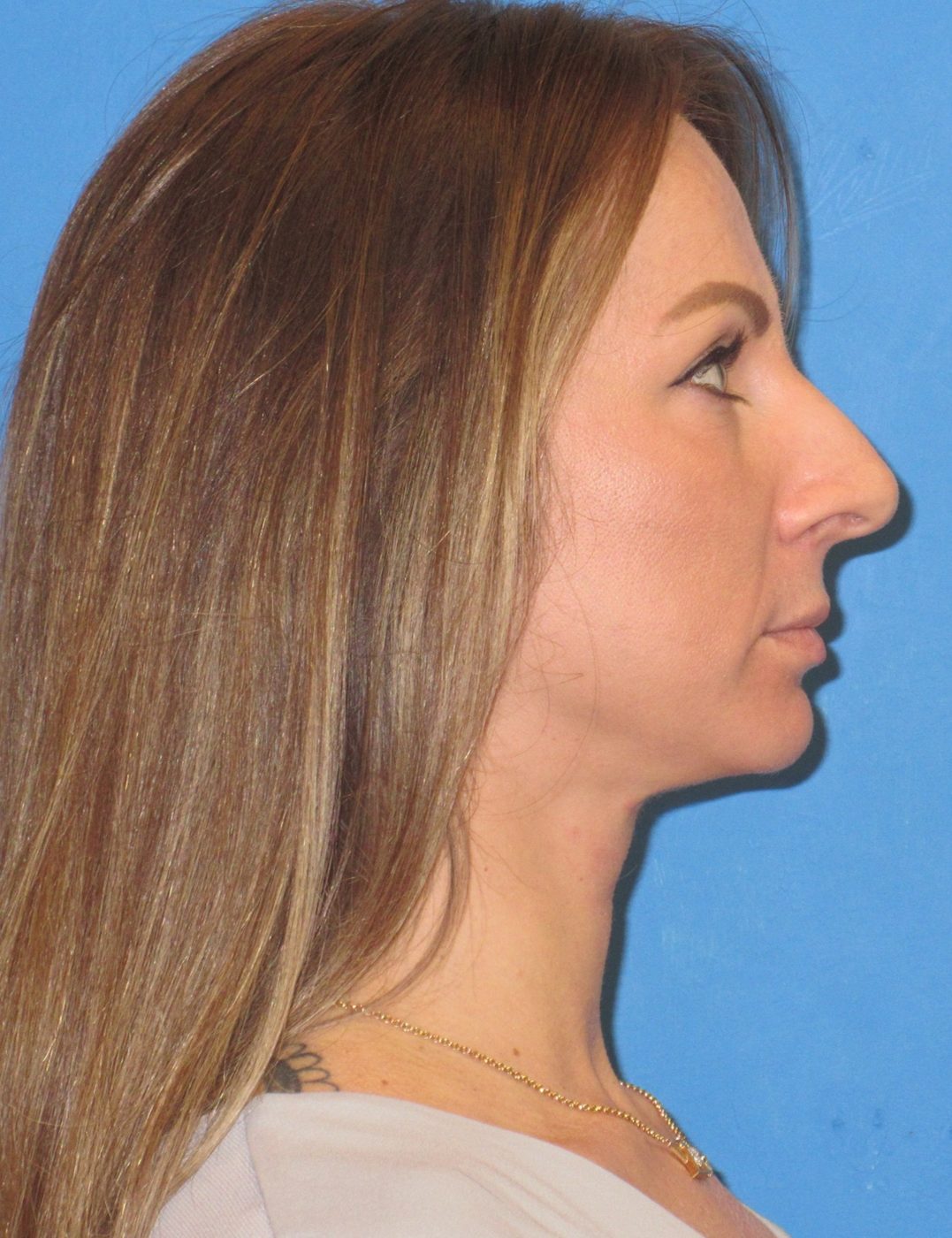 Rhinoplasty before