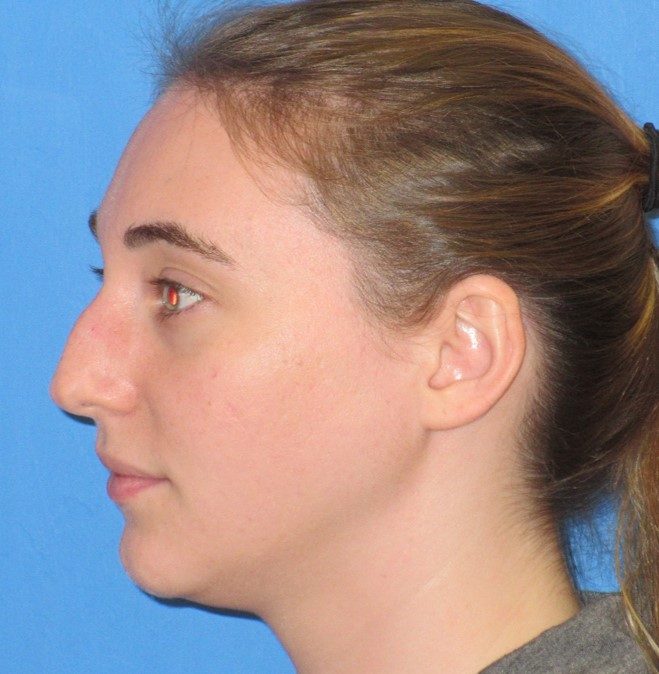 Rhinoplasty before