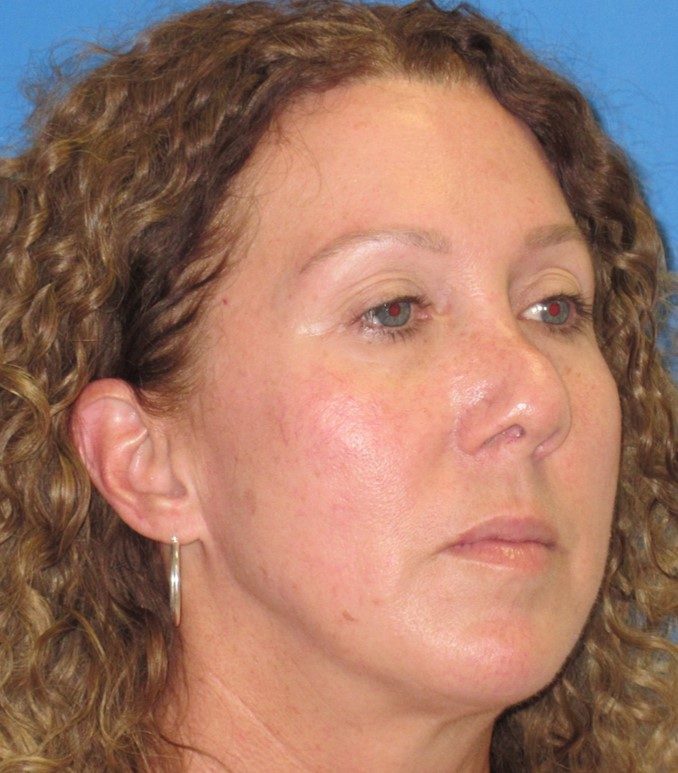 Rhinoplasty before