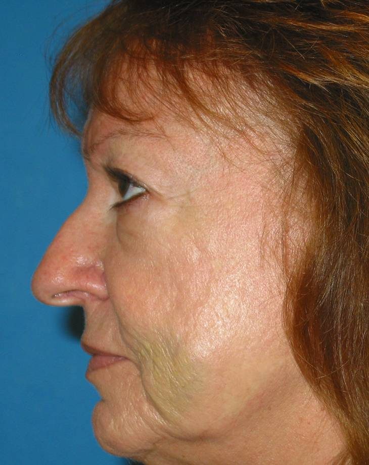 Rhinoplasty before