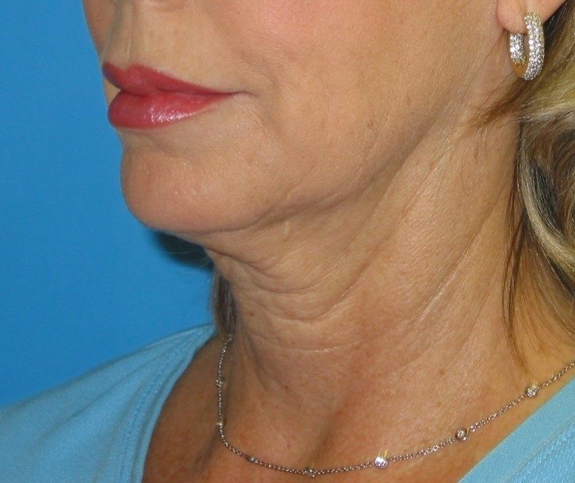 Deep Neck Contouring before