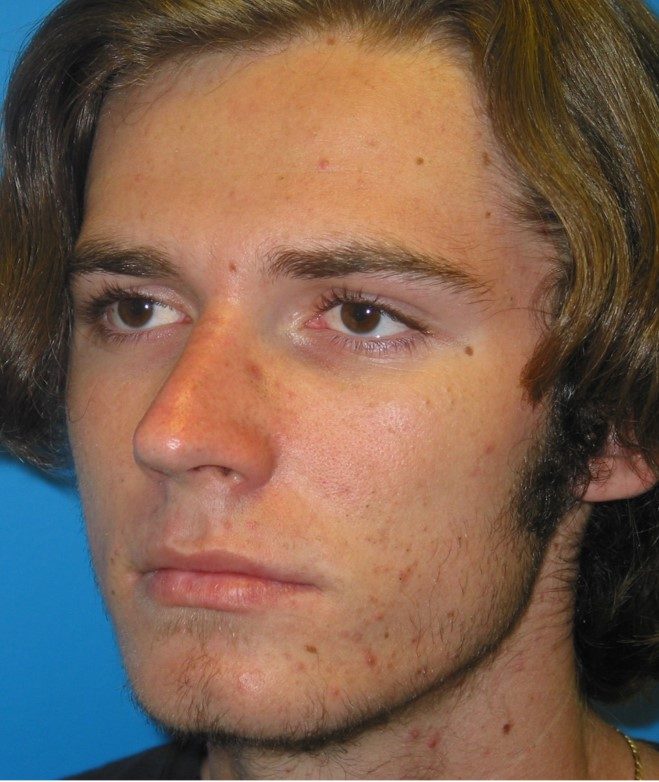 Rhinoplasty after