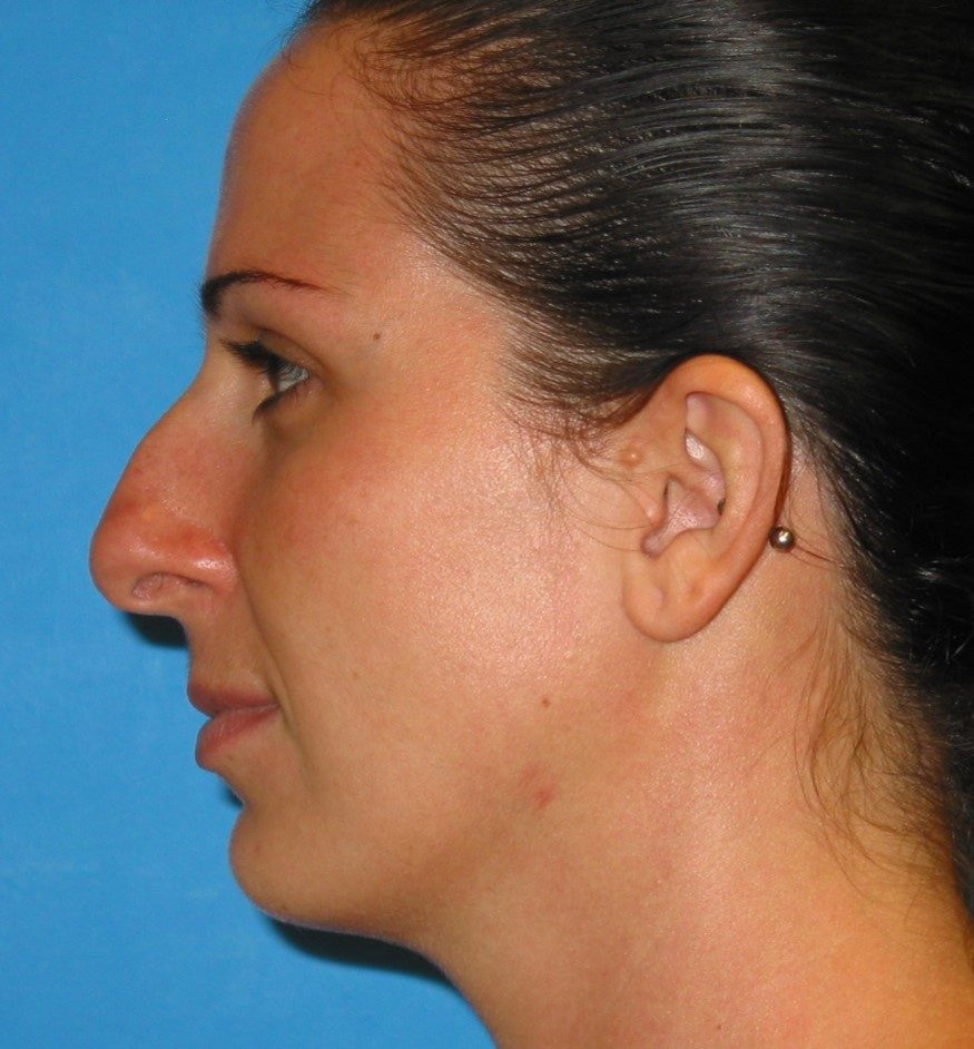 Rhinoplasty before