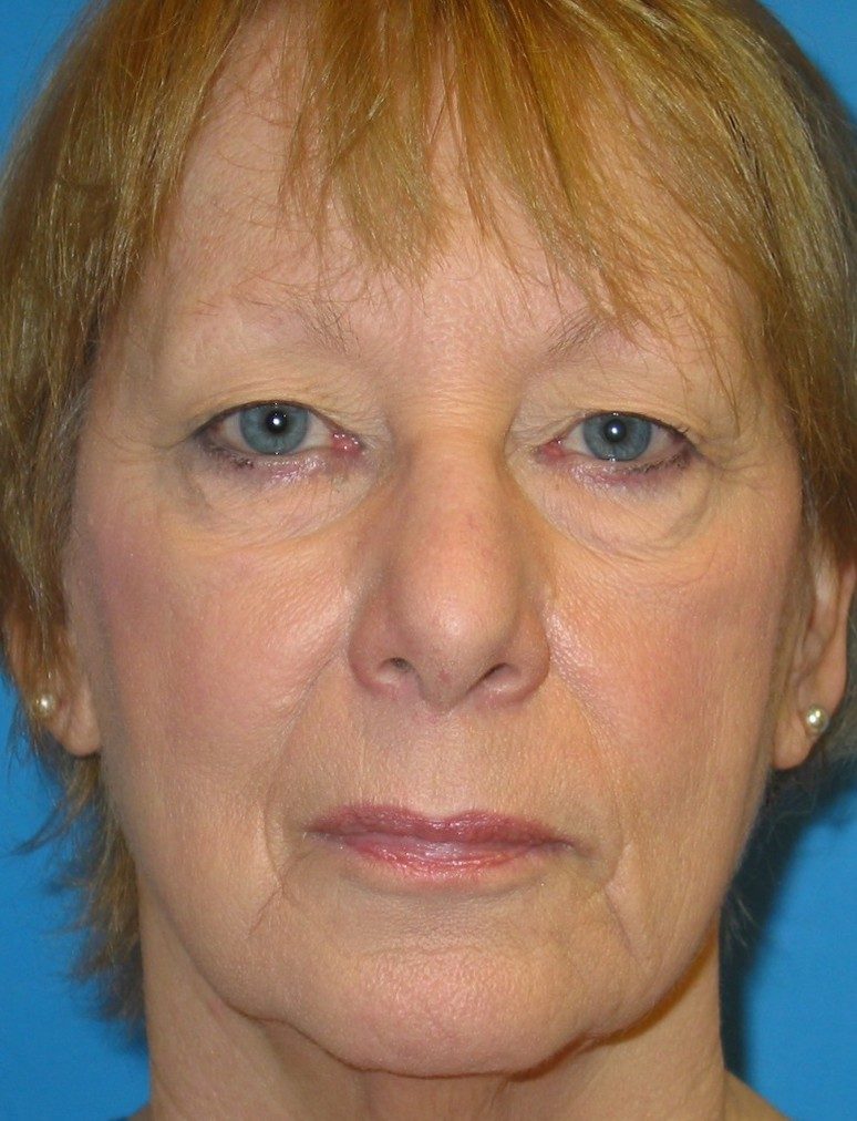 Eyelid Lift before