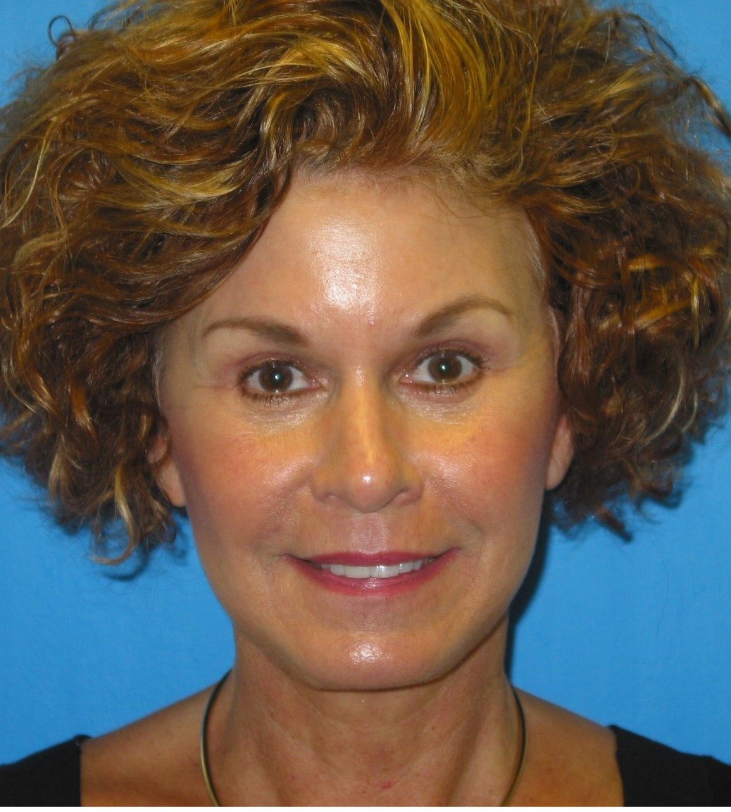 Endoscopic Brow Lift after