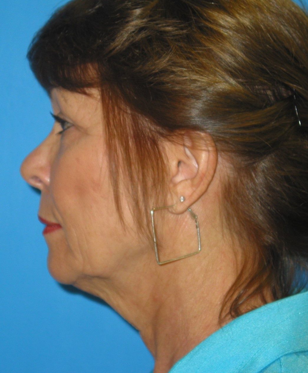 Deep Neck Contouring before