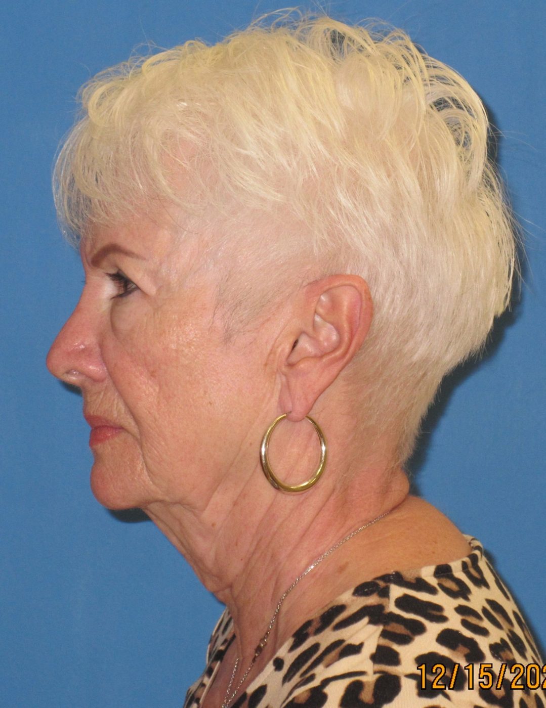 Before — Facelift + Neck Lift