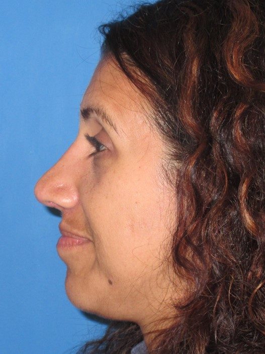 Rhinoplasty after