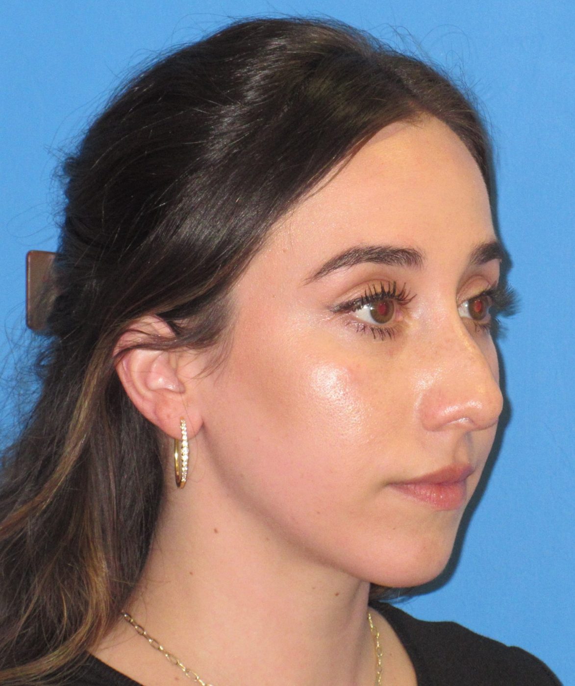 Rhinoplasty before