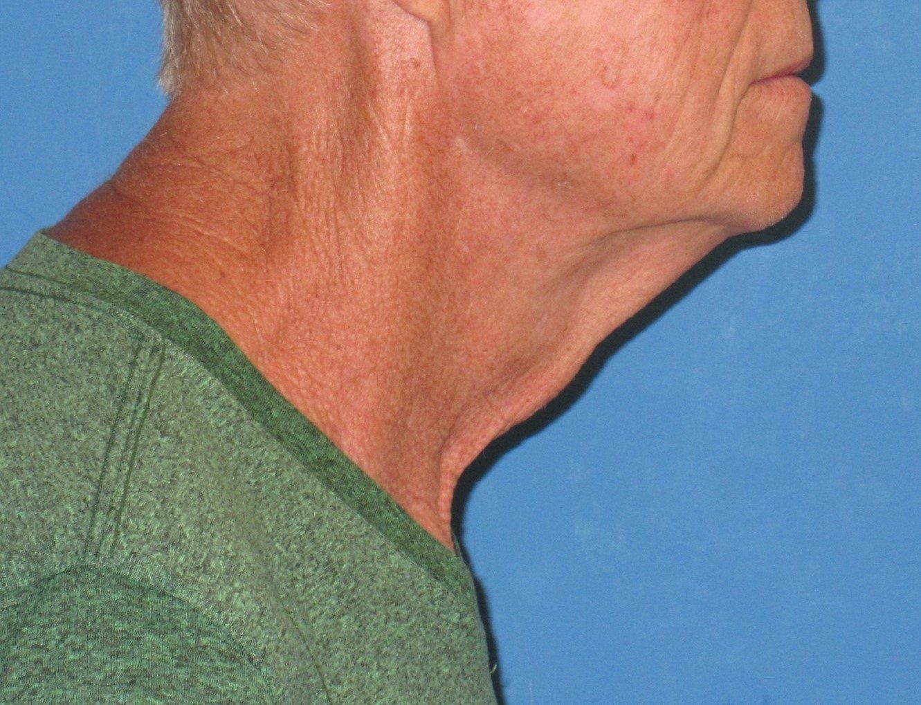 Deep Neck Contouring after