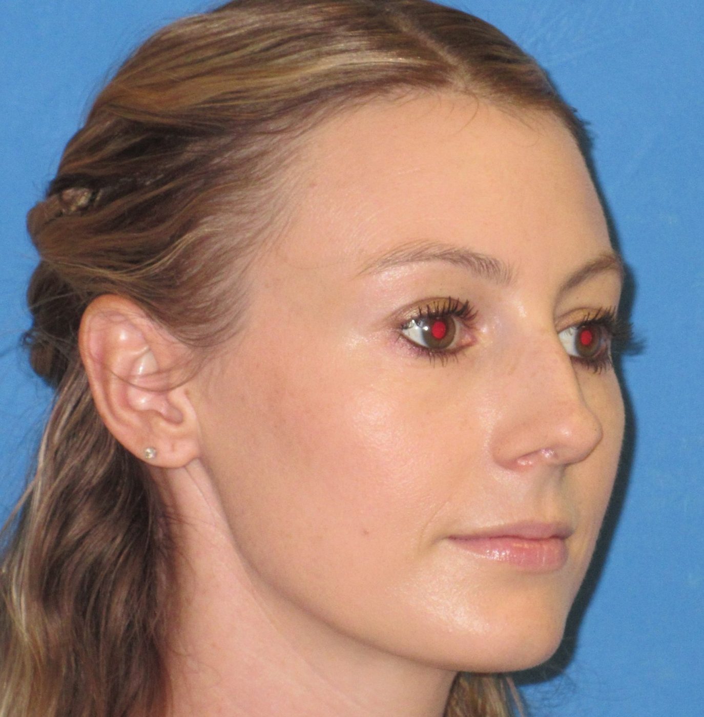 Rhinoplasty before