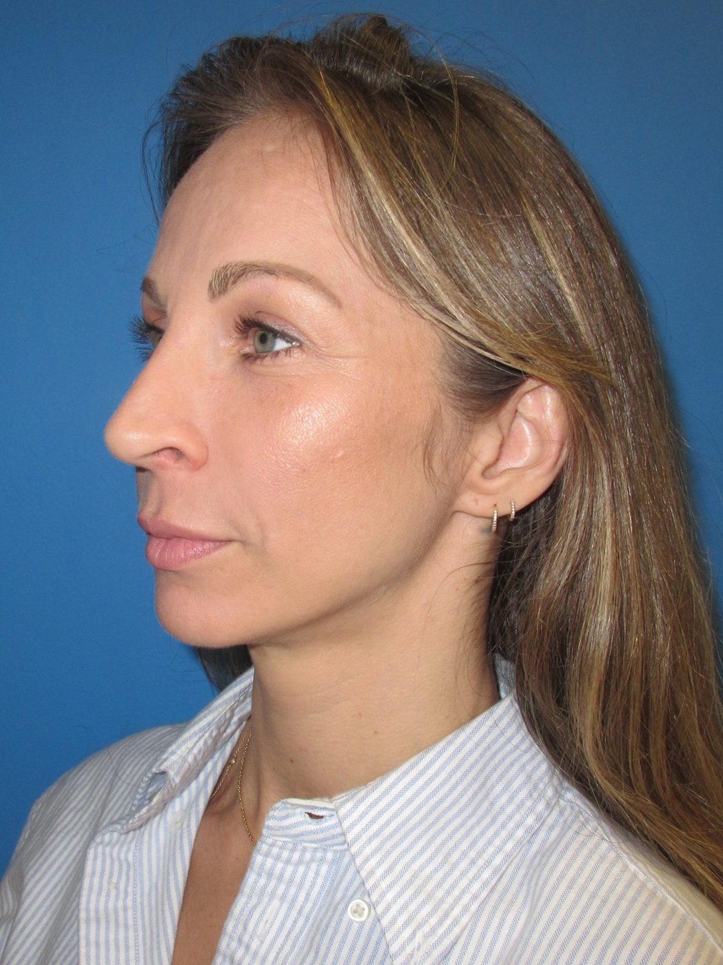 Rhinoplasty after