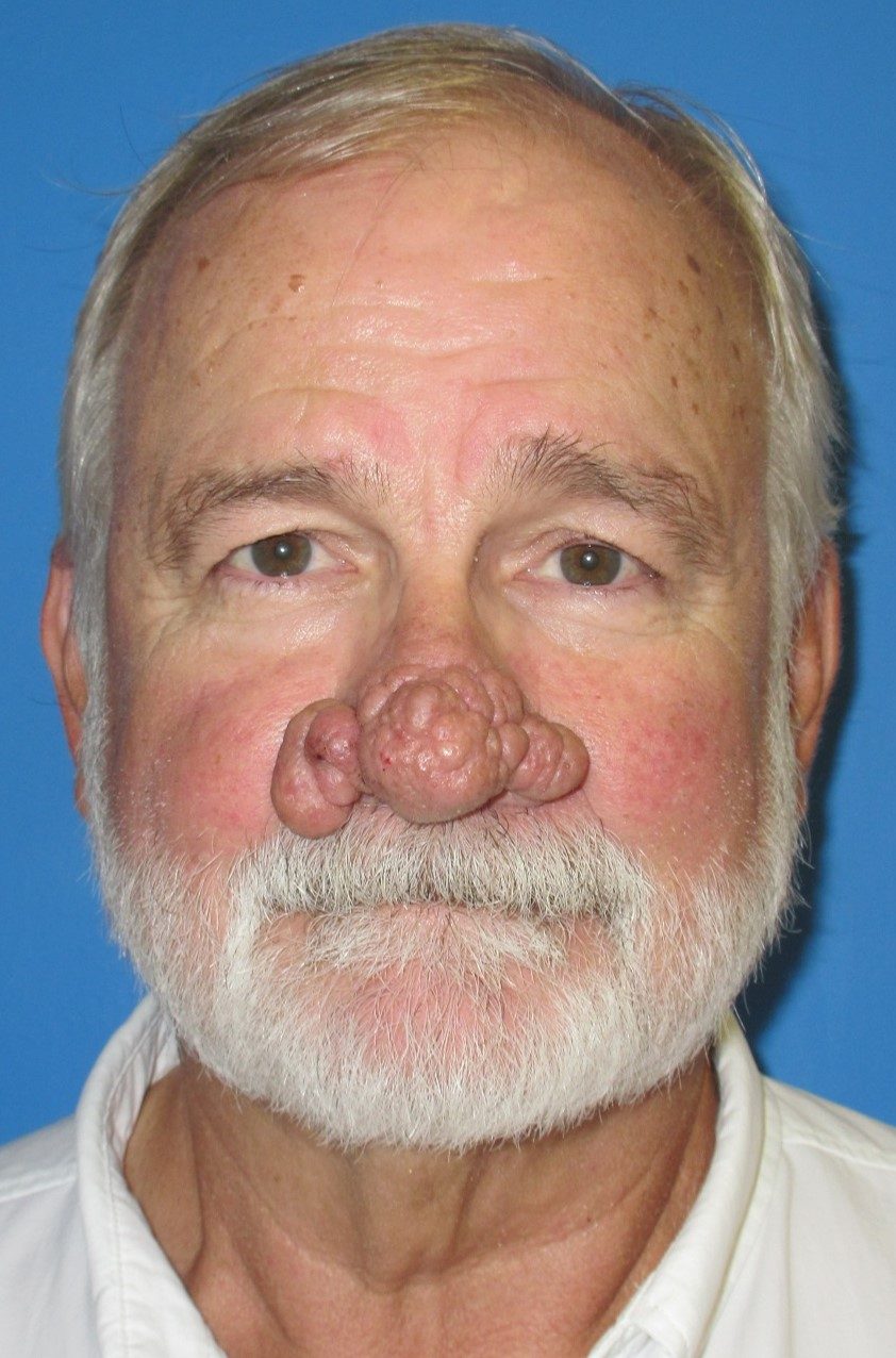 Reconstructive & Laser Therapy before